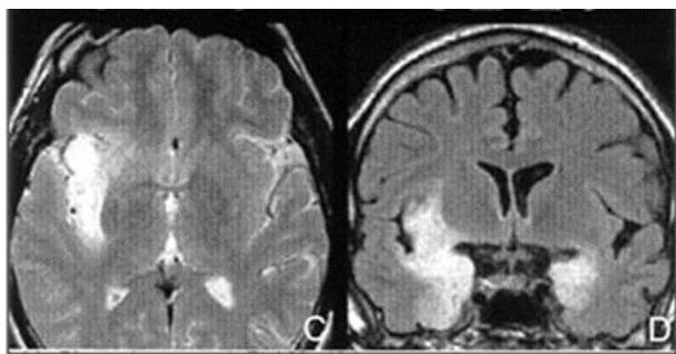 뇌 MRI axial 및 coronal 영상. 우측 insular cortex와 양측 내측 측두엽 부위에 광범위한 고신호강도 병변이 관찰됨.