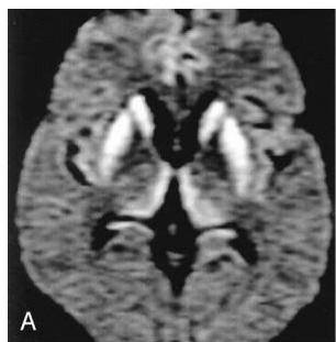 Brain diffusion MRI showing bilateral symmetrical high signal intensity in the basal ganglia (caudate nucleus and putamen).