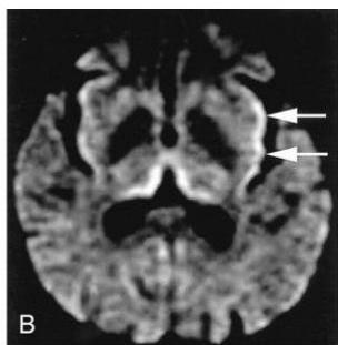 Brain diffusion MRI showing diffuse high signal intensity along the cerebral cortex (cortical ribboning sign), indicated by white arrows.