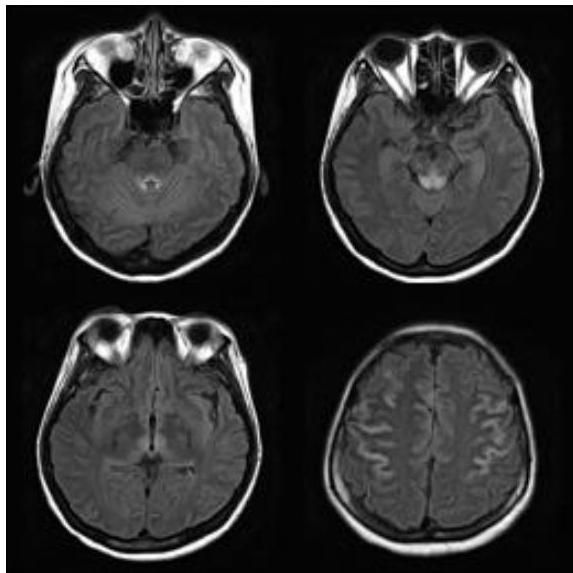 뇌 MRI FLAIR 축상면 영상. 제3뇌실 주변의 시상(thalamus) 내측과 중뇌 수도관 주위 회색질(periaqueductal gray) 부위에 대칭적인 고신호강도가 관찰됨.