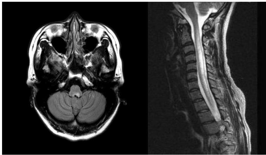 그림 1: Brain MRI FLAIR axial view에서 연수(medulla) 후방의 최후수부(area postrema)에 고신호강도 병변이 관찰됨. 그림 2: Spinal MRI T2 sagittal view에서 경추부터 흉추 상부까지 3개 이상의 척추체를 침범하는 광범위한 고신호강도 병변(LETM)이 관찰됨.