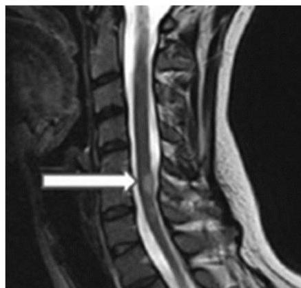경추 시상면 T2 강조 영상(C-spine sagittal T2WI): 경추 하부 척수 내부에 고신호강도의 국소 병변(화살표)이 관찰됨. 병변의 길이는 1개 척추체 정도로 짧음.