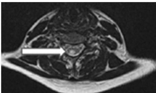 경추 축상면 T2 강조 영상(C-spine axial T2WI): 척수 횡단면에서 우측 후측방(posterolateral) 부위에 치우친 고신호강도 병변(화살표)이 관찰됨.