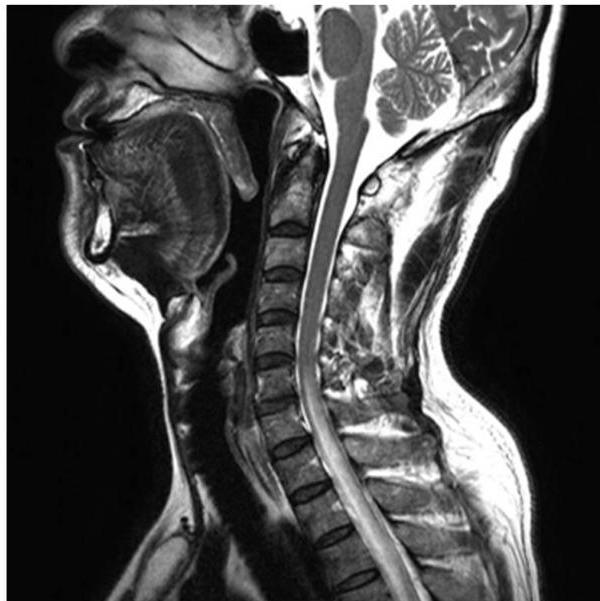 T2 강조 시상면 MRI