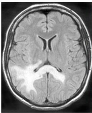Brain MRI FLAIR axial view