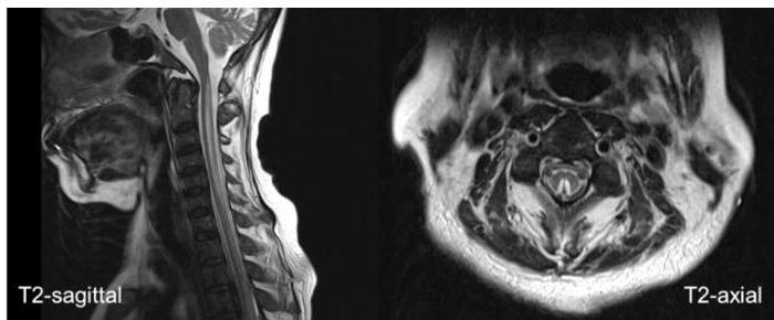 경추 MRI T2-sagittal 및 T2-axial 영상. 경추 전반에 걸쳐 척수 후방부(posterior column)를 따라 선상의 고신호강도가 관찰되며, axial 영상에서 후주 부위의 대칭적인 고신호강도(inverted V-sign)가 뚜렷함.