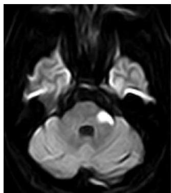 뇌 MRI DWI 영상