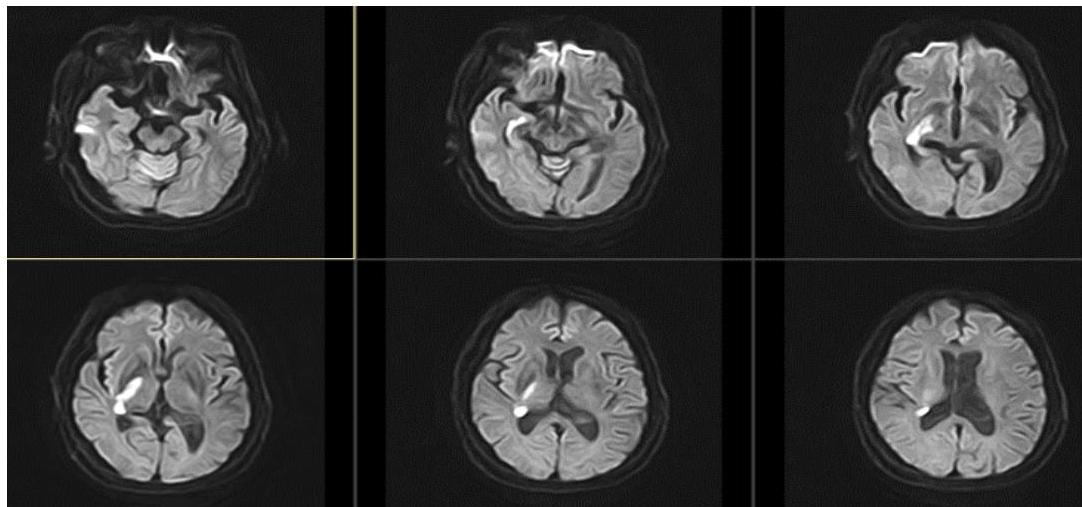 DWI MRI