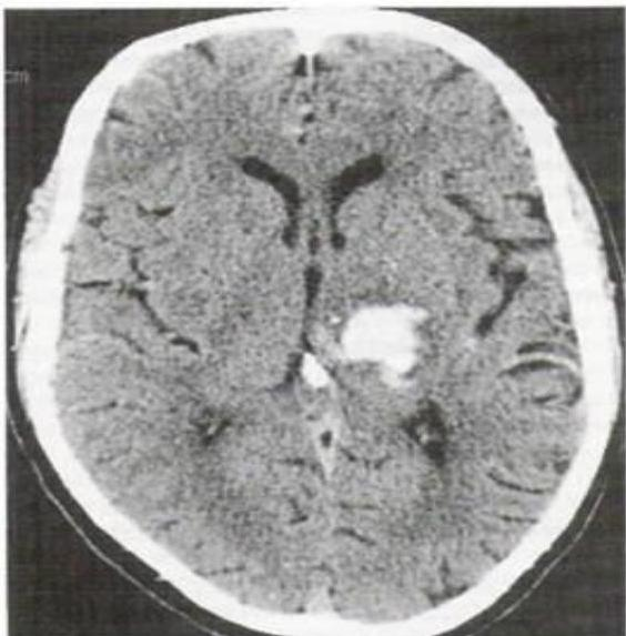 Brain CT