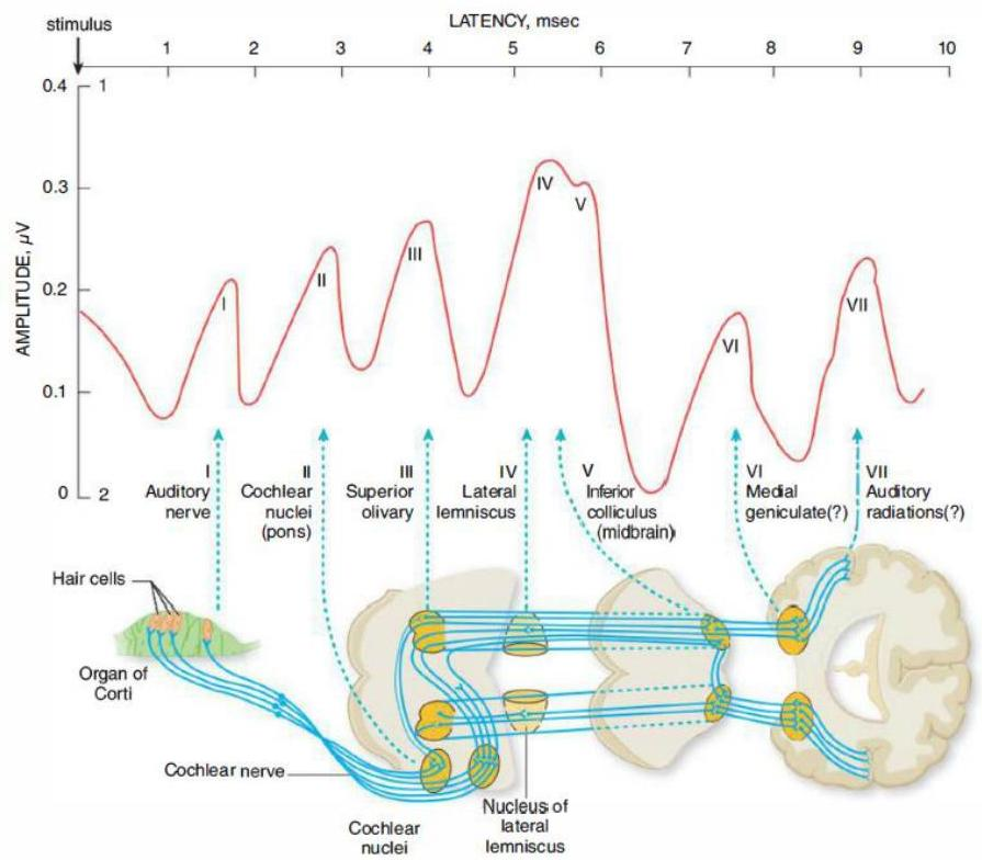청각 경로와 뇌간청각유발전위(BAEP) 파형의 상관관계. Wave I은 Auditory nerve, Wave II는 Cochlear nuclei, Wave III은 Superior olivary complex, Wave IV는 Lateral lemniscus, Wave V는 Inferior colliculus와 연결됨을 보여주는 모식도.