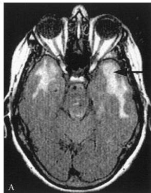 Brain MRI FLAIR axial view showing high signal intensity in both temporal poles (arrow).