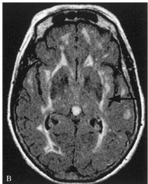Brain MRI FLAIR axial view showing high signal intensity in the external capsules (arrow).