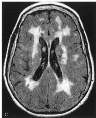 Brain MRI FLAIR axial view showing extensive periventricular and deep white matter hyperintensities.