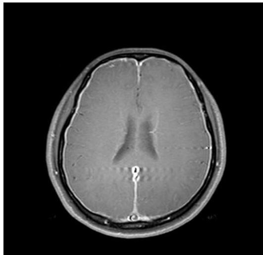 뇌 MRI T1 조영증강 축상면 영상에서 대뇌 반구 전반에 걸쳐 두꺼워진 경막이 강하게 조영증강되는 미만성 경막 조영증강(diffuse pachymeningeal enhancement) 소견이 보임.