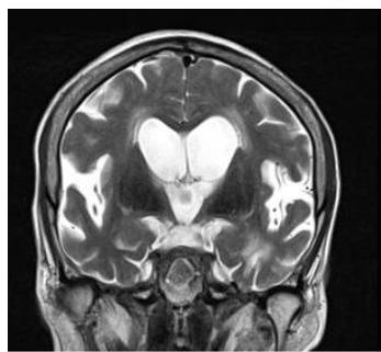 뇌 MRI 관상면 T2 강조 영상: 양측 측뇌실의 확장과 뇌실 주위 고신호강도가 관찰됨