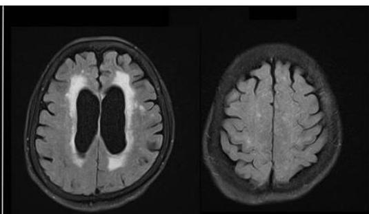 뇌 MRI 축상면 FLAIR 영상: 뇌실 확장 및 뇌실 주위 백질 변성이 보이며, 고위 피질 구홈(high convexity sulci)의 조밀함이 관찰됨