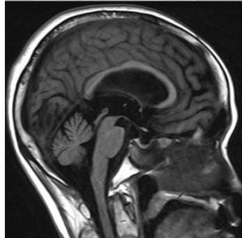 뇌 MRI 시상면 T1 강조 영상: 뇌량(corpus callosum)이 위로 솟아 있고 뇌실이 확장된 소견