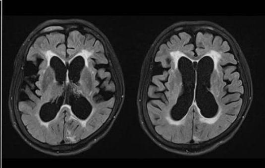 뇌 MRI 축상면 FLAIR 영상: 전두분(frontal horn)과 측두분(temporal horn)의 뚜렷한 확장이 관찰됨