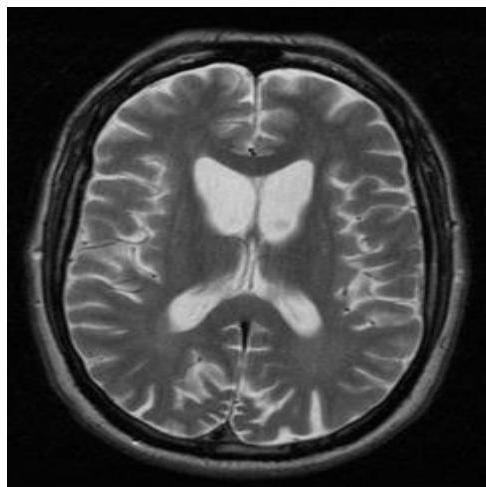 뇌 MRI T2 강조영상 축상면(Axial view). 양측 꼬리핵(caudate nucleus)의 위축으로 인해 측뇌실의 앞뿔이 사각형 모양으로 확장된 'box-car appearance'가 관찰됨.