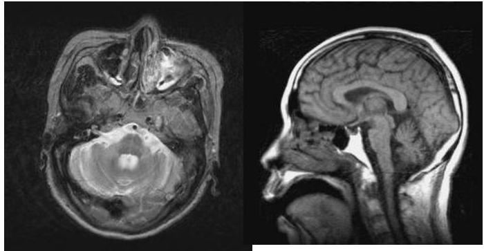 뇌 MRI