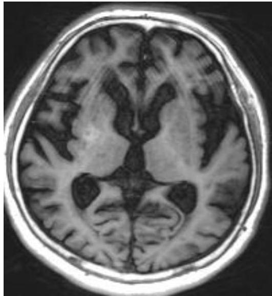 뇌 T1 강조 MRI 영상. 우측 선조체(striatum) 부위에 국소적인 고신호강도(high signal intensity) 소견이 관찰됨.