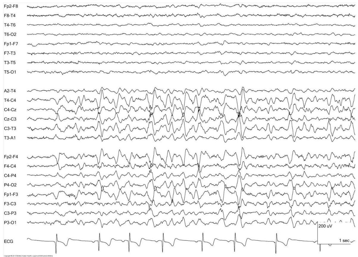 뇌파 검사 결과: 전반적인 서파와 함께 극서파 복합체(spike-and-slow wave complexes)가 관찰되는 뇌파 소견