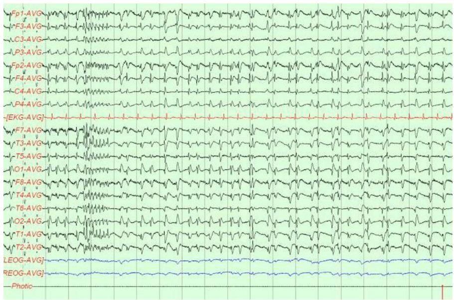EEG showing Generalized Periodic Discharges (GPDs)