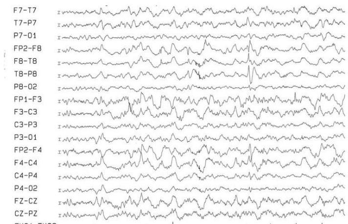 EEG