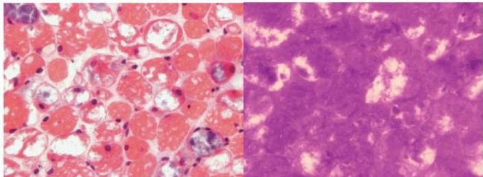 근조직 생검 소견. 좌측 H&E 염색에서 근섬유 내 다수의 공포(vacuole)가 관찰되며, 우측 PAS 염색에서 공포 내 글리코겐 축적으로 인한 진한 보라색 염색 소견이 보임.
