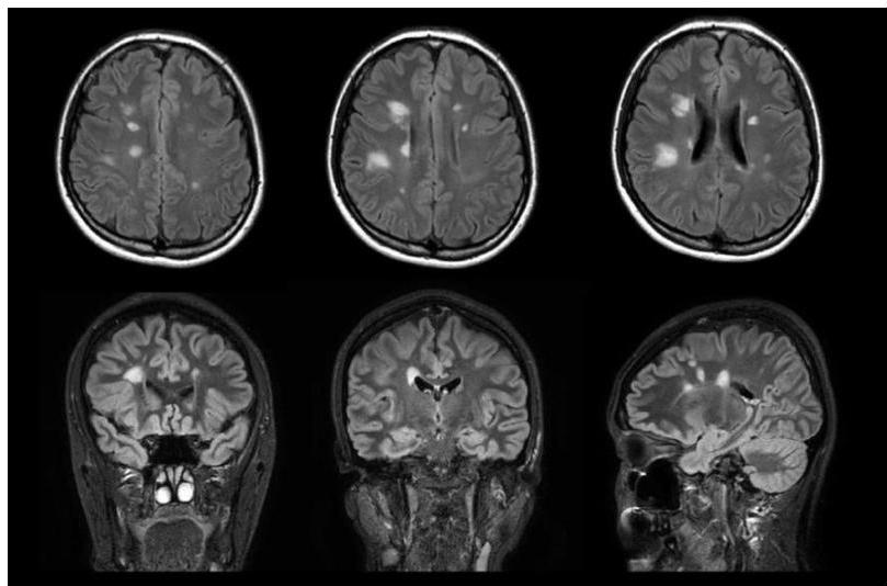 뇌 MRI FLAIR 영상