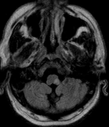 MRI T2/FLAIR axial view showing high signal intensity in the left lateral medulla, consistent with lateral medullary infarction.
