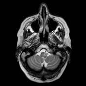 뇌 MRI axial T2 영상에서 왼쪽 아래올리브복합체(Inferior olivary complex) 부위의 고신호강도와 비대 소견이 관찰됨.