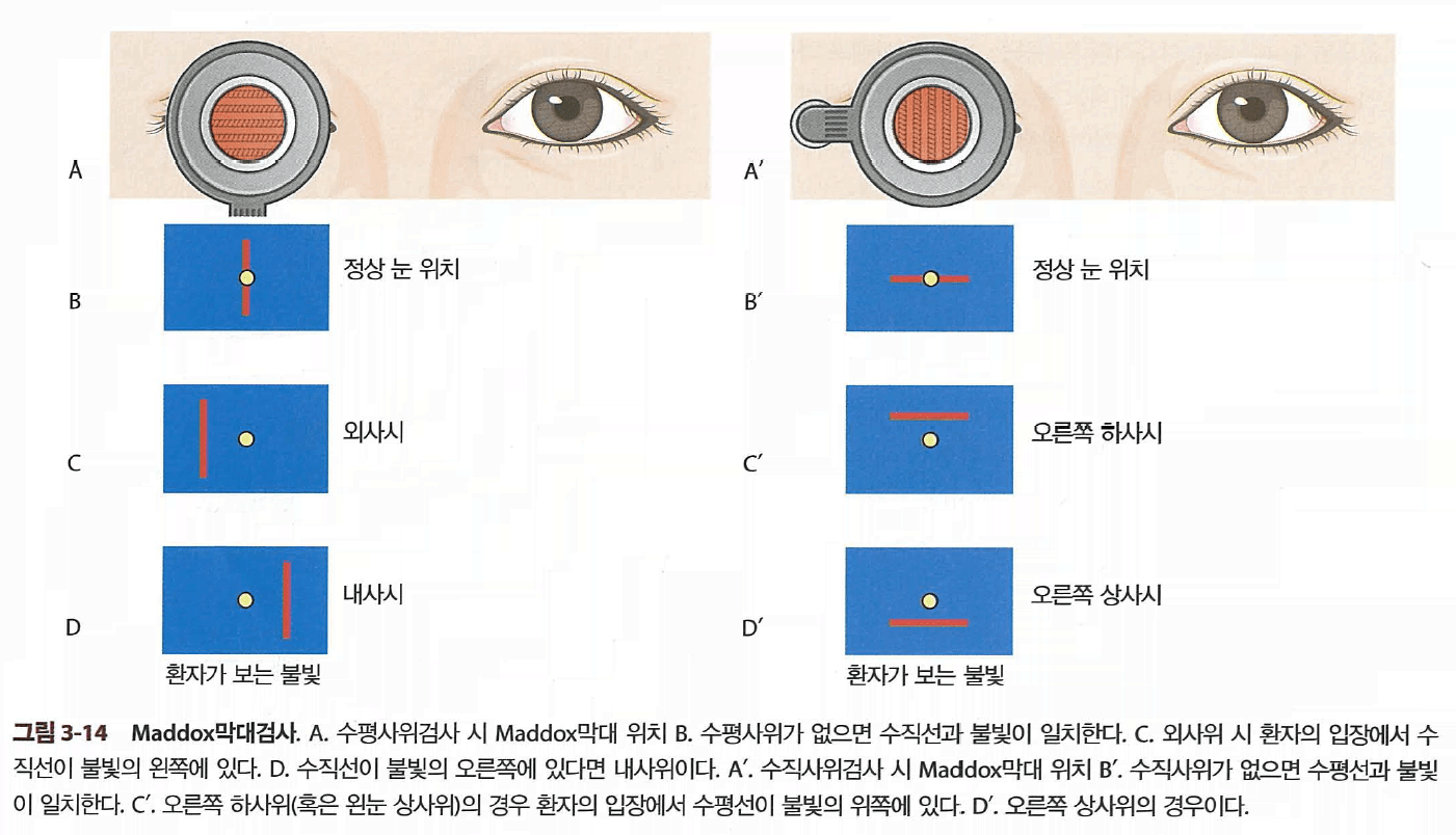 Maddox 막대검사의 원리 및 사시 종류별 소견 요약도