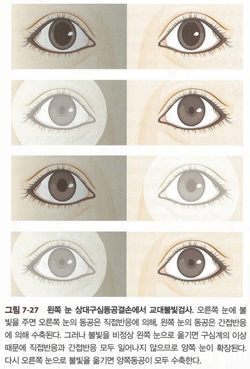 상대구심동공결손의 기전 및 교대불빛검사 모식도