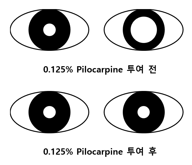 동공부등 접근 알고리즘