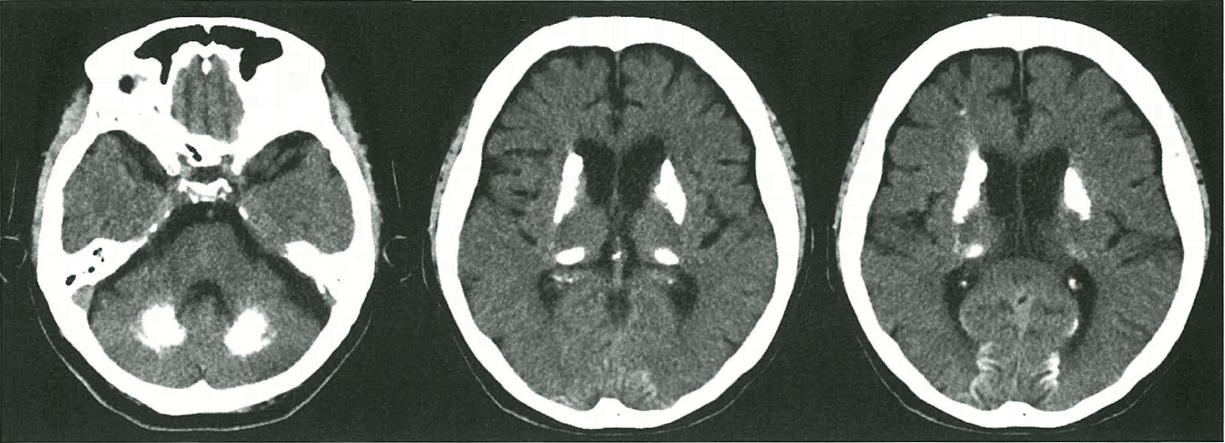 뇌 CT 영상. 축상면(Axial view) 세 컷에서 양측 기저핵(Basal ganglia), 시상(Thalamus), 소뇌 치아핵(Dentate nucleus) 및 피질하 백질 부위에 광범위하고 대칭적인 고음영의 석회화 소견이 관찰됨.