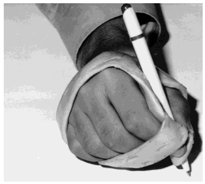 Writer's cramp 환자가 글씨를 쓸 때 손목과 손가락을 고정해주는 보조기(hand orthosis)를 착용하고 있는 모습