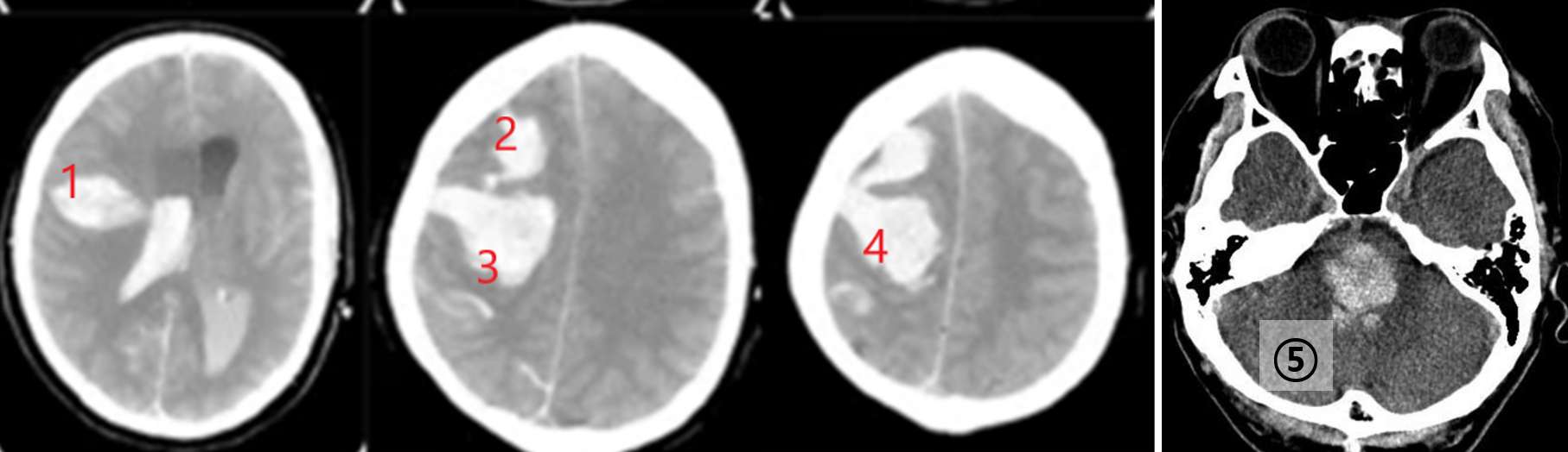 Brain non-contrast CT: Multiple intracranial hemorrhages including EDH, SDH, and brainstem/ventricular involvement.