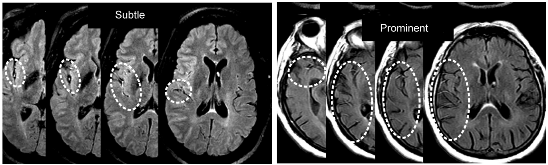 Examples of BBB breakdown on CE-FLAIR and other imaging modalities.
