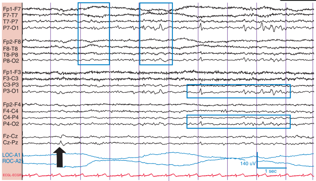 Annotated EEG with POSTs and Vertex waves