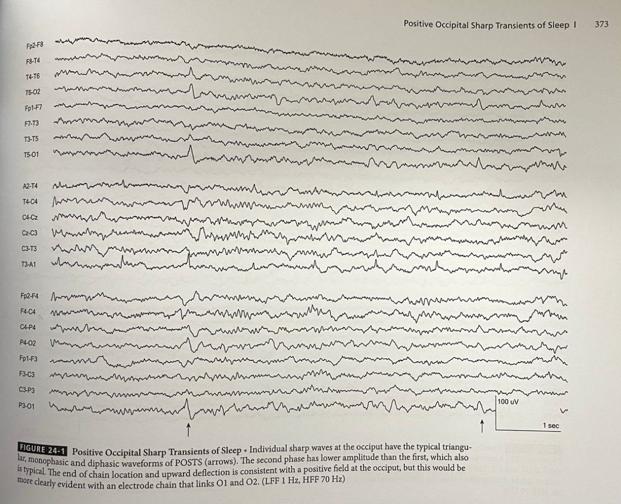 EEG showing POSTs