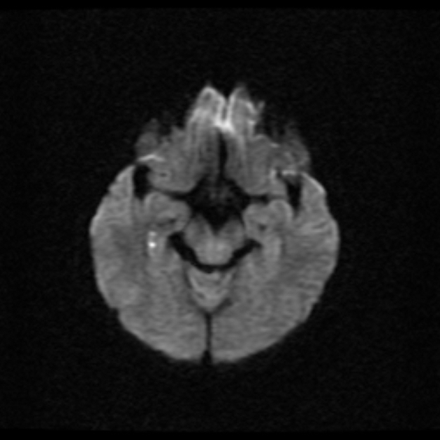 DWI MRI: 해마 부위의 전형적인 TGA 병변 소견