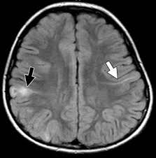 결절성 경화증 환자의 뇌 MRI: 뇌실막하 결절(Subependymal nodules) 소견