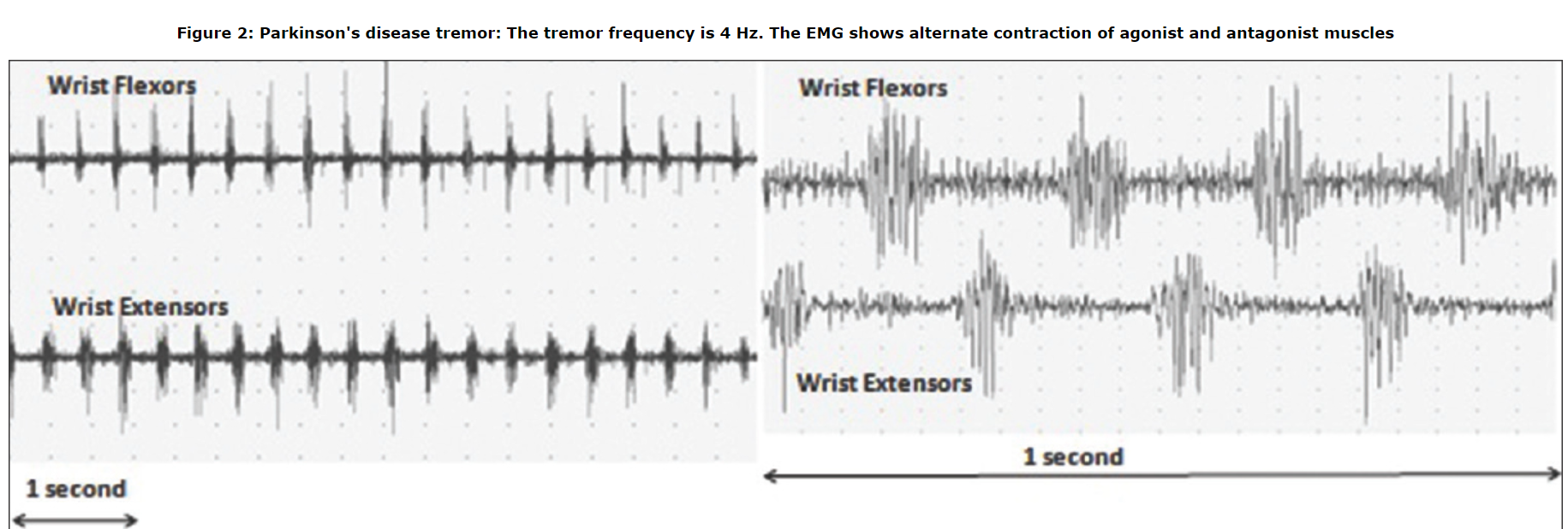 Comparison of PD and ET EMG patterns