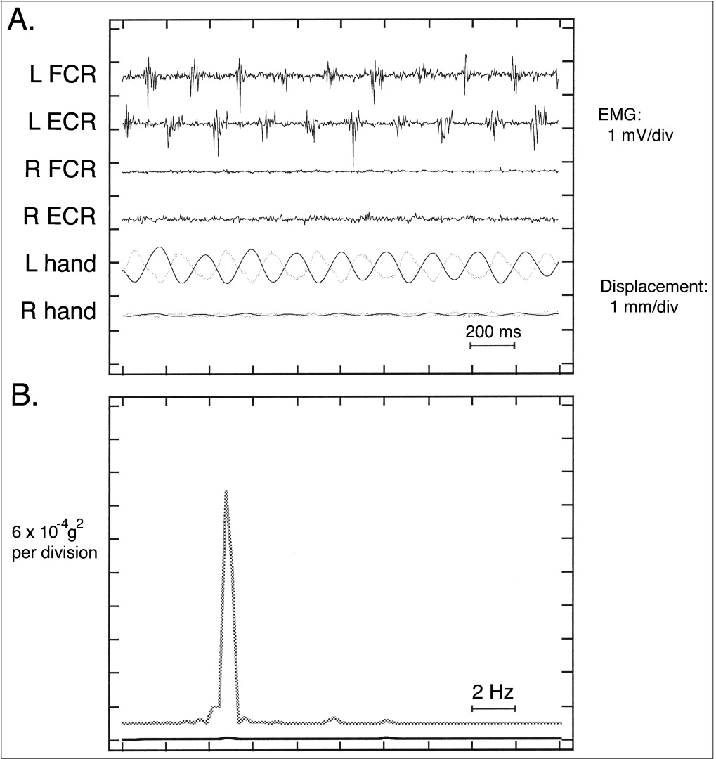 PD rest tremor EMG detail