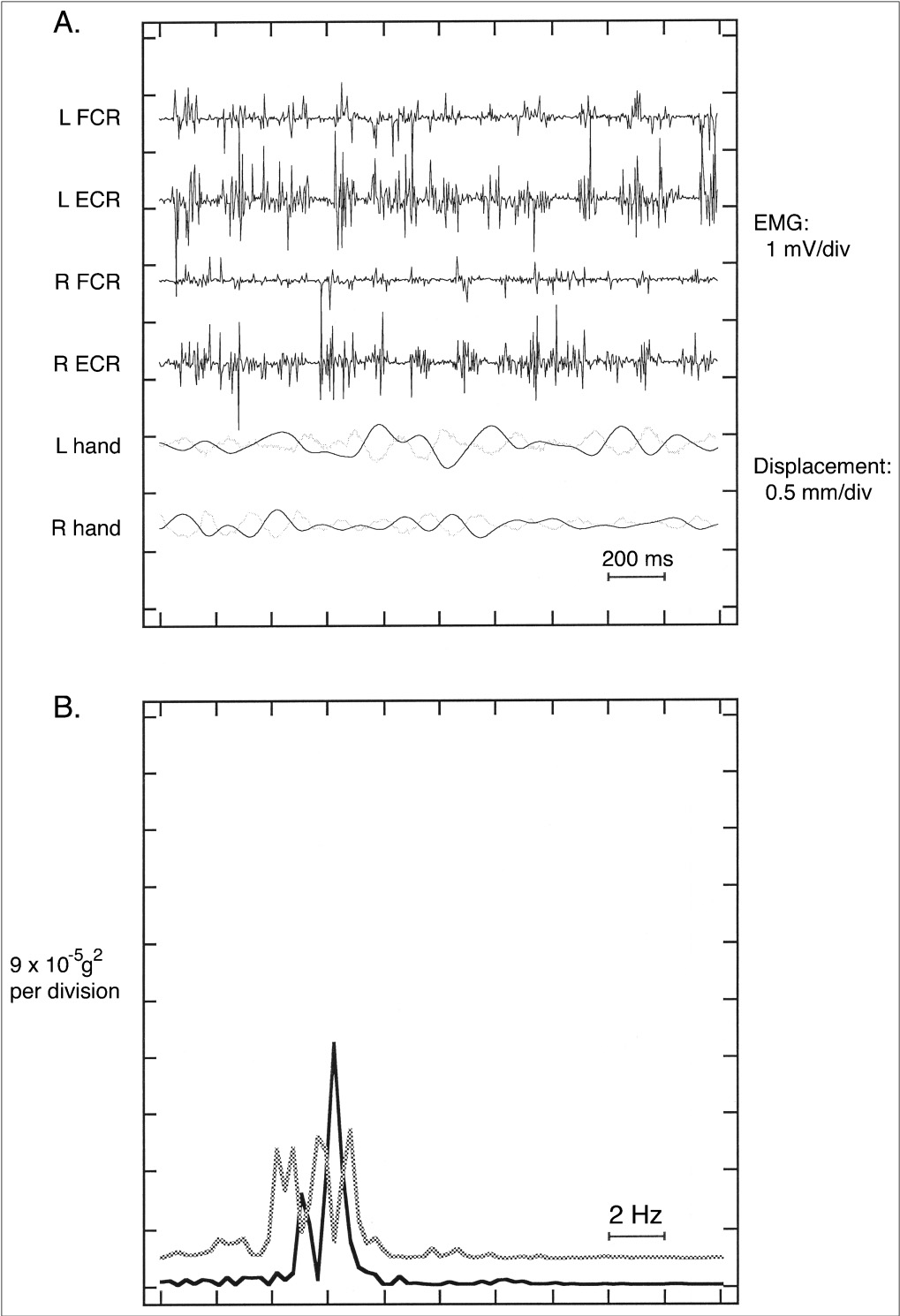 Essential tremor EMG detail
