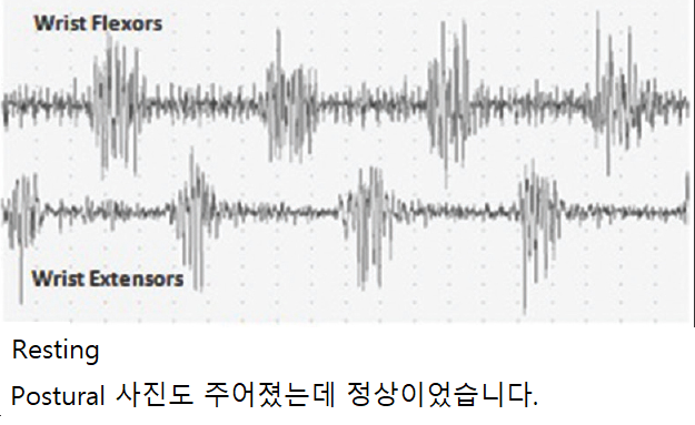 Surface EMG showing alternating activity in flexor and extensor muscles
