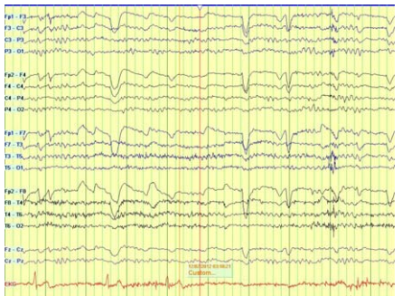 EEG showing ictal activity