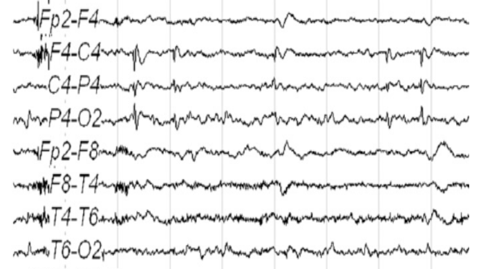 ECG showing sinus arrest during seizure