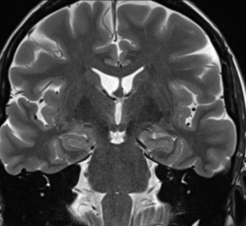 Brain MRI T2 Axial - Normal